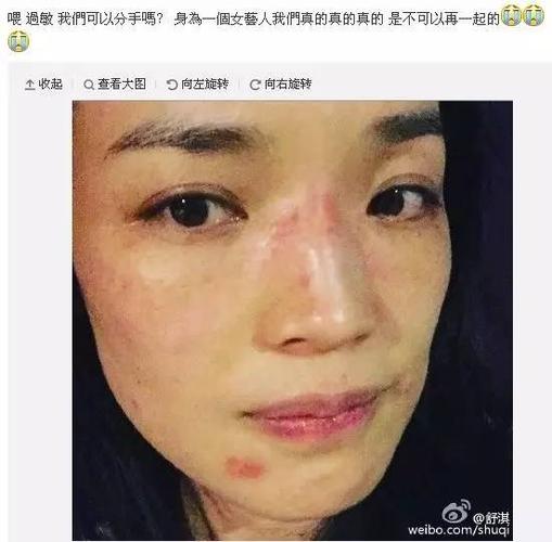 如果反复发作就是颜面再发性皮炎, 中医叫做桃花癣, 最近门诊前来