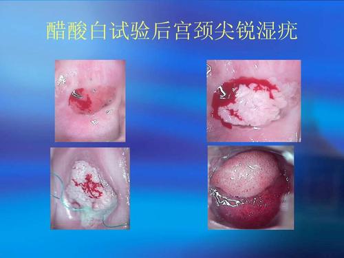 醋酸白试验后宫颈尖锐湿疣