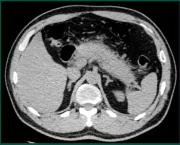急性胰腺炎(胰腺水肿)