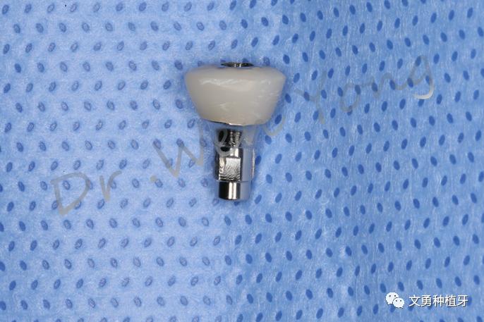 这种种植牙技术只需两次