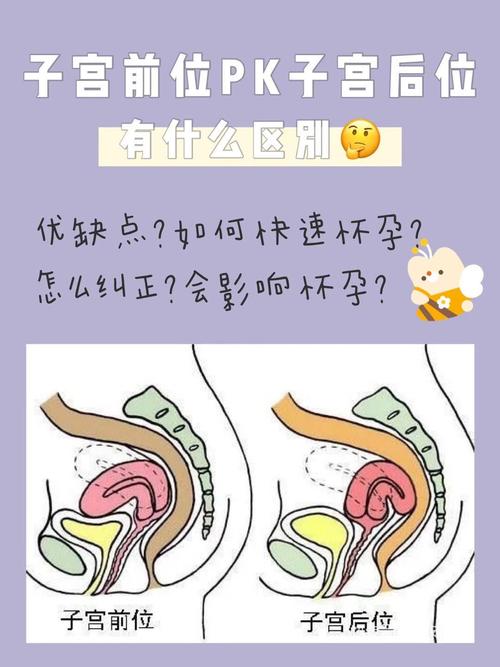 子宫前位/子宫后位那种更容易怀孕?有区别吗