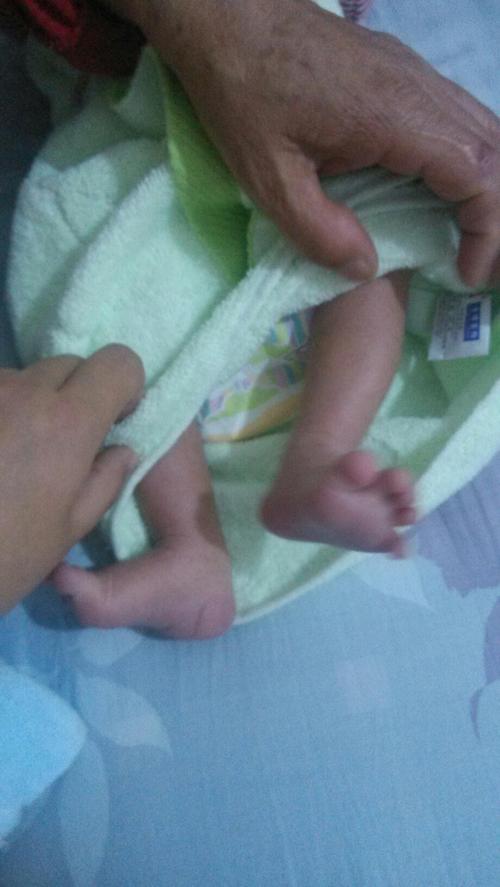 新生儿右脚外翻怎么办?求助