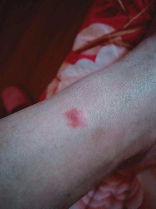 最近两个月,脚踝脚背交替长出这样的红疹,钻心的痒,也