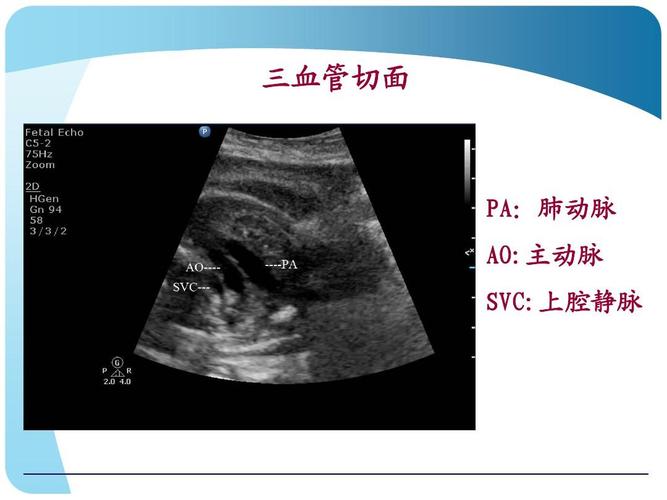 三血管切面 pa:肺动脉 ao:主动脉 svc:上腔静脉