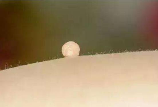 身上突然长出小「肉疙瘩」到底是什麼?会不会发生癌变?