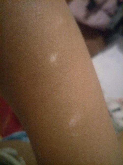 胳膊上毛细孔出现白点怎么回事?