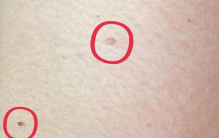 原创脖子上长出了小肉粒不只影响美观或会让身体健康说no