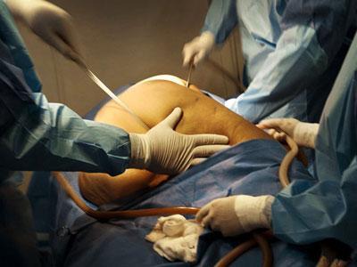 抽脂肪对身体有害吗?