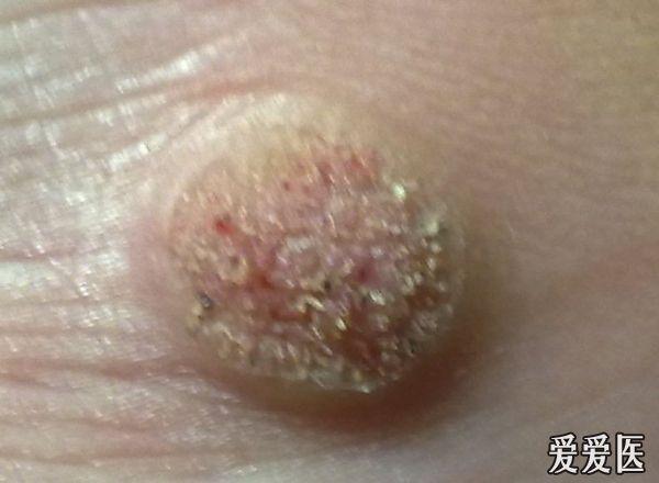 帮我看看,这是情况~脚上的~ - 皮肤及性传播疾病讨论版 - 爱爱医医学