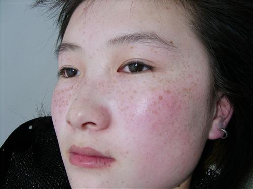 形成雀斑的主要原因?