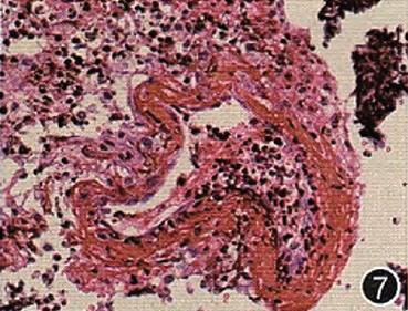 【转帖】疑难病例讨论:间断出现肺部空洞4年