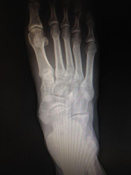 请骨科医生帮我看看这张片子