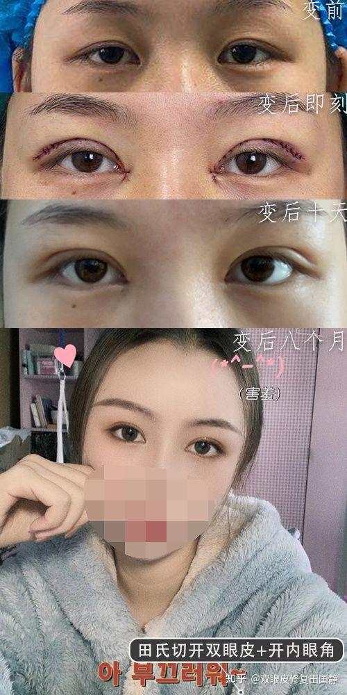 七毫米的双眼皮宽不宽呀?