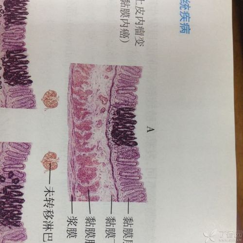 胃粘膜中粘膜层,上皮层,固有层,黏膜肌层,基底膜,粘膜下层,这些结构从