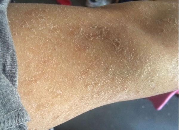 皮肤糠疹一开始是红点,两三天就好