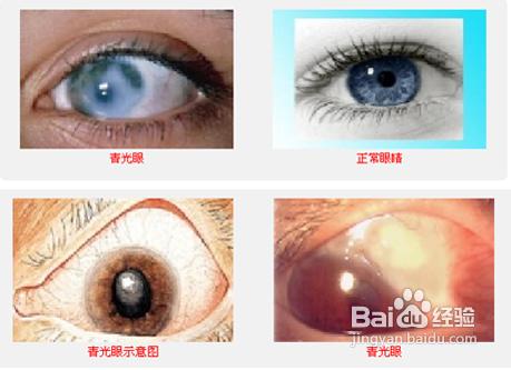青光眼:发病迅速,危害性大,随时导致失明的常见疑难眼病.