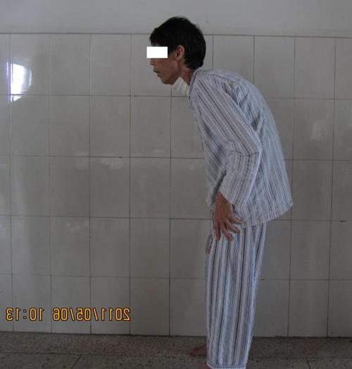 一例高难度脊柱后凸畸形矫正手术