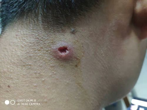 前些天长了个疖子 然后熟了挤了现在成这样了 这是感染了嘛求解答.