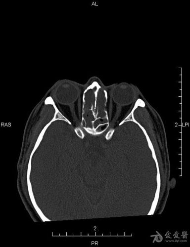 鼻窦ct