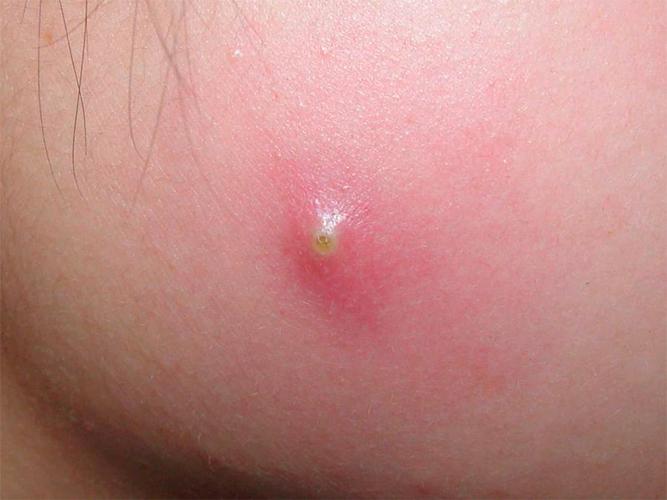 腺总是相连的,所以成熟之后的毛囊炎或接,总是有一个脓头或脓栓形成