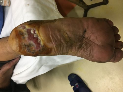 糖尿病足跟坏疽微粒皮种植加速愈合