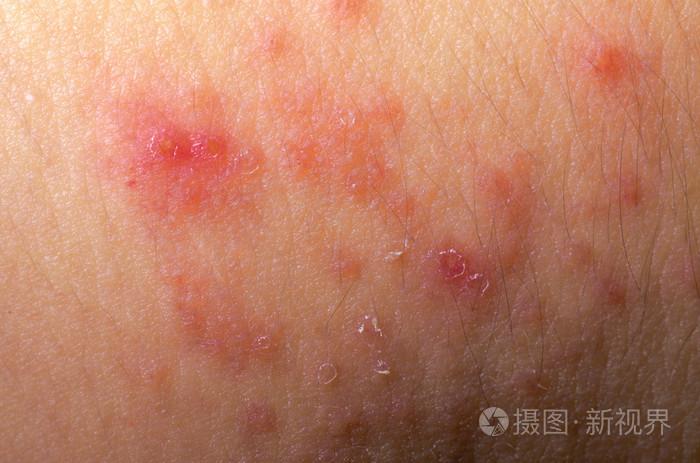 湿疹特应性皮炎症状皮肤纹理