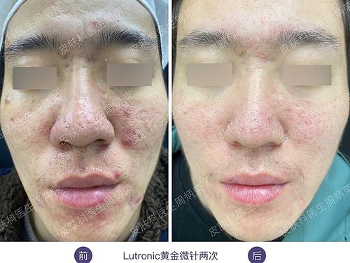 治疗前痘坑,毛孔粗大,出油严重等问题#拯救毛孔行动