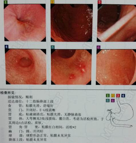 诊断 处理 诊断:胃窦溃疡,萎缩性胃炎.