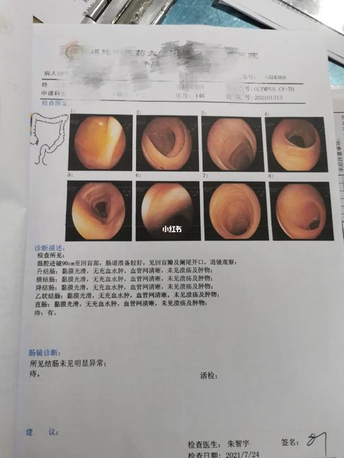 胃肠镜检查_肠胃_清肠_中药_hpv_熬夜_面条_医疗健康