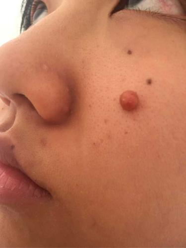 长了一个像肉瘤一样的东西三个多月到现在基本已停止变大开始是肤色