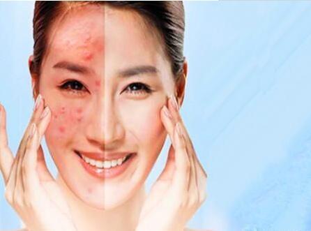 激素脸初期症状图片什么方法治疗激素脸效果好