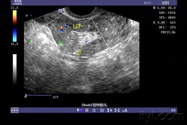 超声诊断子宫穿孔并大网膜嵌顿1例