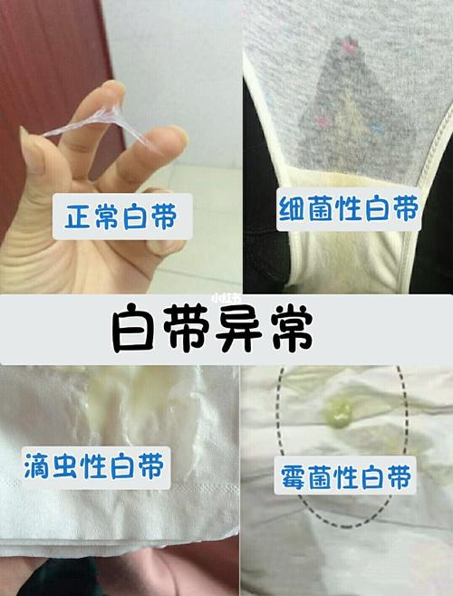 细菌性阴道焱75_妇科_内裤_沐浴产品_经期_熬夜_增强抵抗力_白带