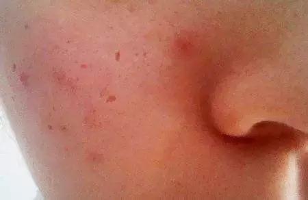 痘印一般分为红色痘印跟黑色痘印