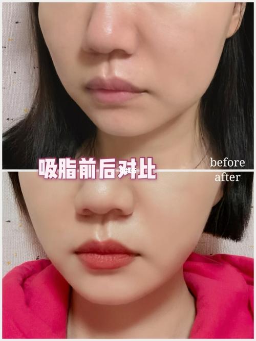 吸脂做完一个月了,我个人觉得效果还是不错的,首先是重点区域口角囊袋