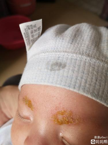 宝宝眉毛上面有黄黄的结痂有谁知道是怎么回