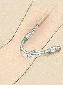 邮医61科普经外周静脉穿刺中心静脉置管您应该知道的那些事儿一