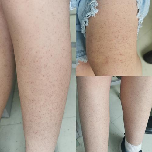 简单说说毛周角化毛发苔癣