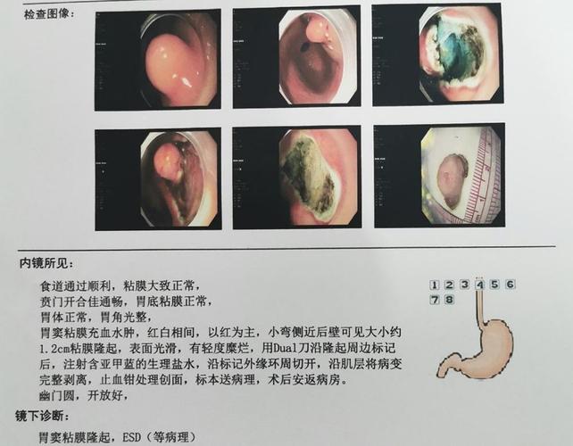 小探头破解大秘密-记信阳市中心医院一例超声内镜检查