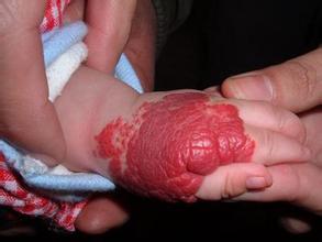 混合型血管瘤消退过程