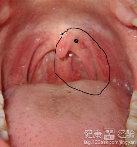 白喉是很严重的病吗