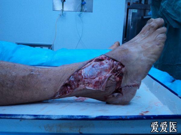 右胫腓骨下段粉碎性开放性骨折