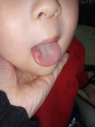 三岁宝宝舌头上这个是怎么回事