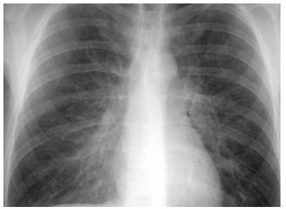 图7 感染性间质性肺炎胸部正位片可见双侧弥漫性间质性改变,痰培养