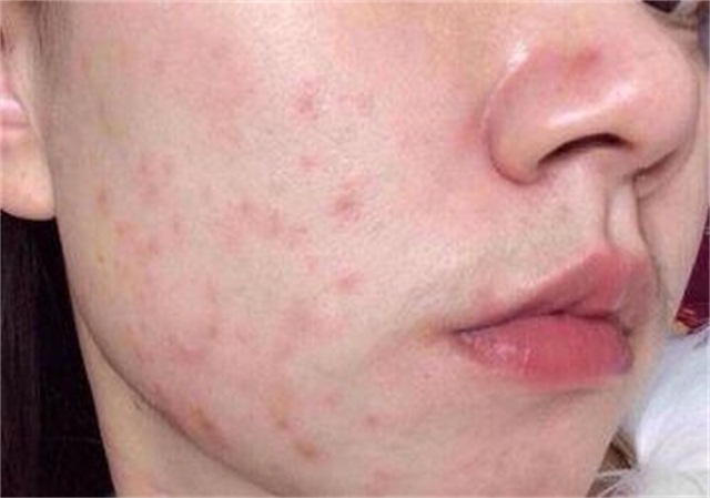 你到底是过敏,敏感肌还是激素脸?没搞清就乱用护肤品难怪烂脸