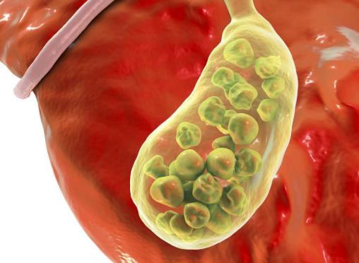 胆结石是如何形成的胆结石有哪些症状