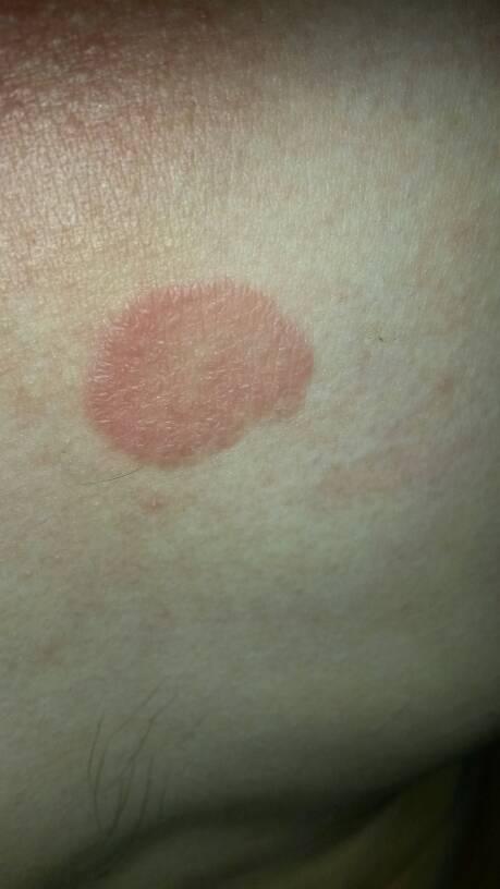 田甜 医师 怀孕两个月左右,出现红斑,医生说是多形红斑皮肤病