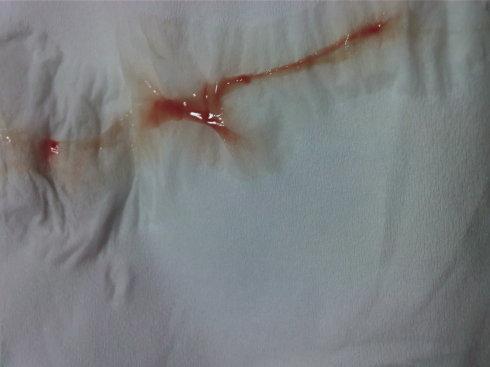 备孕第七十九天——血性白带!