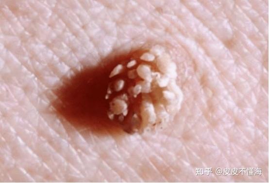 要知道,在生活中也有一些男性会感染上这个病毒,于宫颈癌病变不同