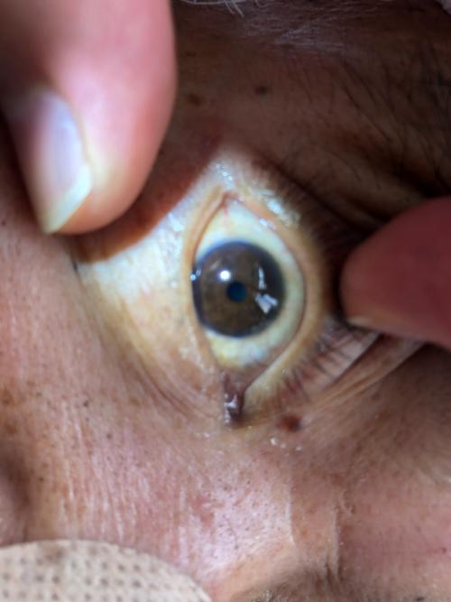 术后病人双侧瞳孔恢复正常.自主呼吸恢复!